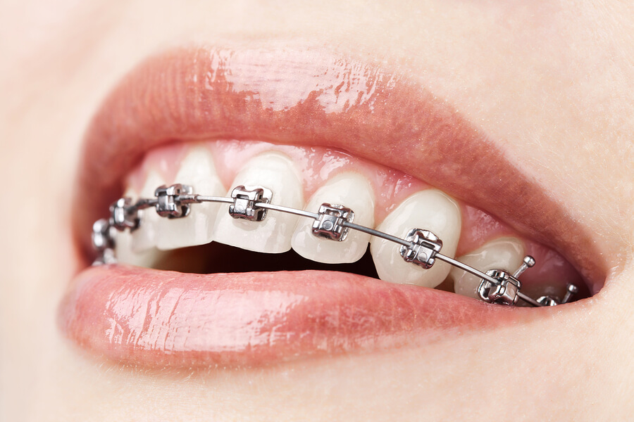 Traditional Braces- Dawn Gayken, DDS