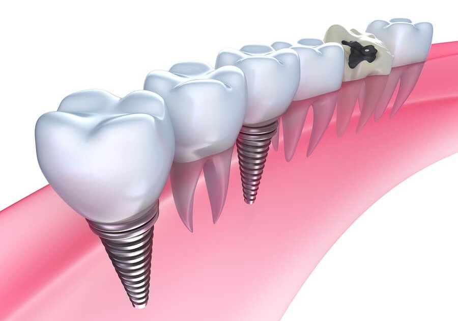 Dental Implants- The Woodlands, TX